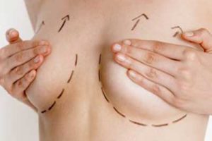 la mastopexia de aumento eleva el pecho caido y aumenta el volumen con prótesis mamarias