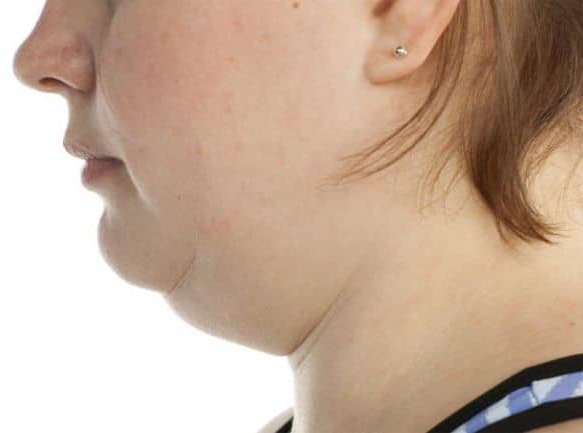 operacion de papada o reduccion de papada: ¿como quitar la grasa debajo del mentón o barbilla