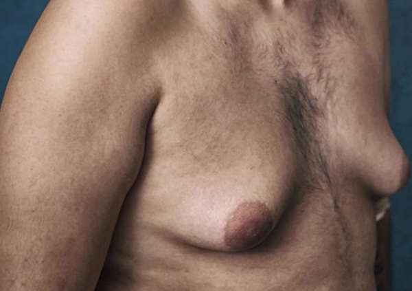 Sintomas Ginecomastia: pechos de hombre con aspecto de senos de mujer con tratamiento quirúrgico