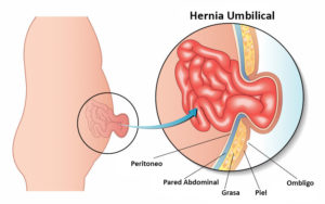 Abdominoplastia con Hernia Umbilical, Abdominal y Diastasis Dr. Moltó