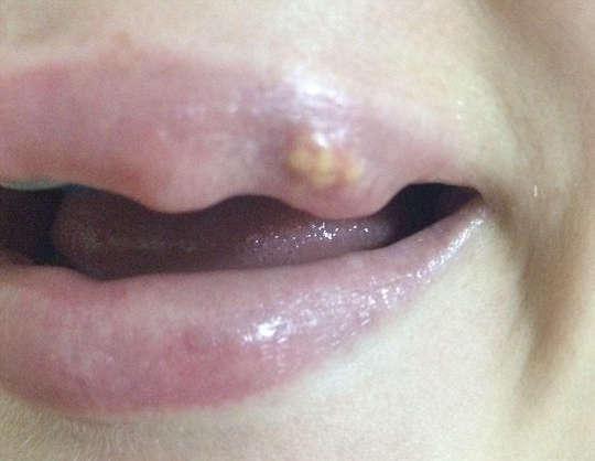 los rellenos permanentes sinteticos en los labios pueden ocasionar granulomas y otras complicaciones