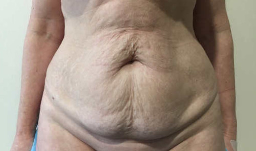 operacion de exceso de piel en el abdomen