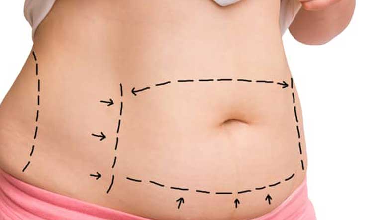 Abdomen perfecto - Beneficios de la abdominoplastia